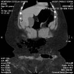 HERNIA TRAUMATICA0034